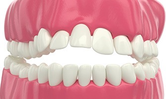 Invisalign can help correct a crowded arch