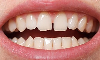 Patients with gaps between their teeth can often benefit from Invisalign