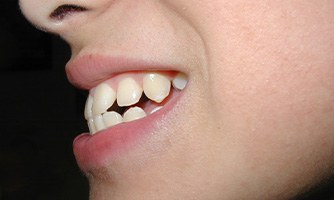 Overbite is a common issue that can be treated by Invisalign