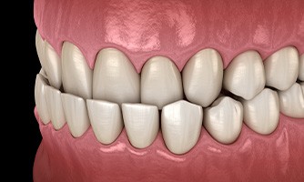 An underbite is another issue that can be treated with Invisalign