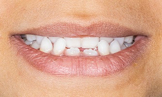 Your dentist may be able to correct your crossbite with Invisalign