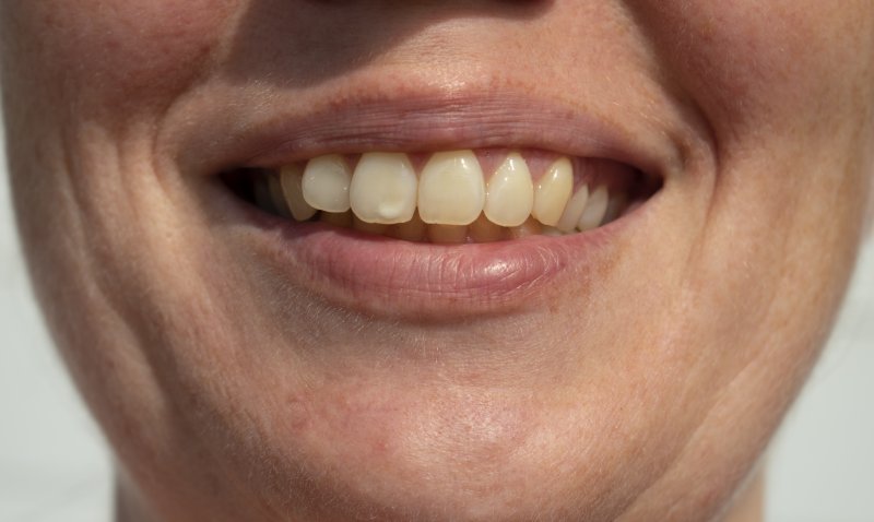 Woman with white stain on tooth